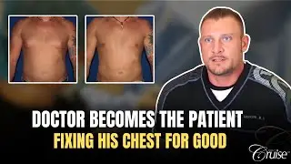 ER Doctor has Gynecomastia Surgery to Improve Body Image | Man Boob Surgery