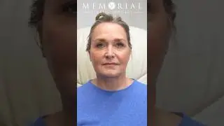 Facelift, Neck Lift, & Bleph: 2-Month Glow-Up Reveal with Memorial Plastic Surgery!