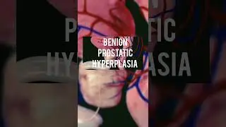 # benign prostatic hyperplasia # shorts # YouTube # anatomy # physiology # neet aspirants