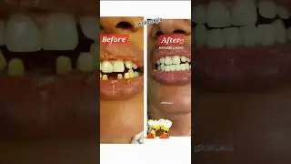 replacement of missing teeth withtooth coloured crowns
