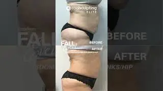 Learn Aesthetics with Lazaderm - CoolSculpting