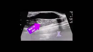 Aneurisma de Vena Yugular externa derecha. Mujer 24 a&ntilde;os. El aumento de volumen desde hace 04 a&ntilde;os
