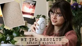Я использовала IPL только на одной стороне в течение 3 месяцев. 🦵 Результаты крупным планом