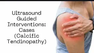 #ultrasound Guided Interventions: Cases (Calcific Supraspinatus Tendon) #sportsmedicine #fyp