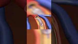 coronary stent restores blood flow to the heart