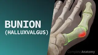 Вальгусная деформация большого пальца стопы (Hallux Valgus)