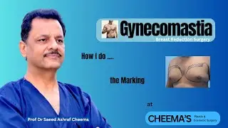 Plastic Surgery. Gynecomastia. Marking for Breast Reduction Surgery. For Plastic Surgeons only