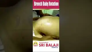 Breech Baby Rotation. #baby #hospital