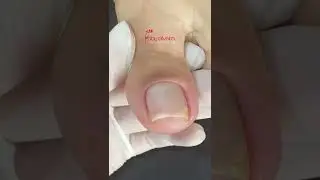 Cuticulagem dos p&eacute;s