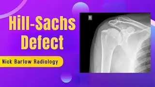 X-Ray Interpretation of Hill-Sachs Defect