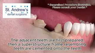 Bridges - Dental Bridges can replace missing teeth. Speak to your Dentist today !