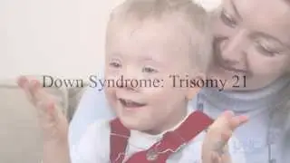 Down Syndrome:  Trisomy 21 Screening