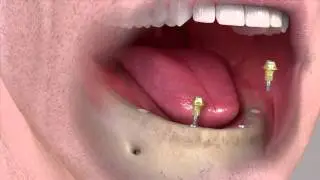 Proth&egrave;se hybride fixe sur implants