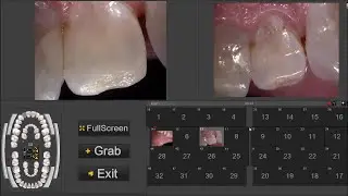 How to acquire & use intra-oral camera images in CADI