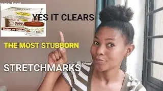 HOW TO REMOVE  VERY OLD STRECHMARKS/HOW TO PREVENT STRETCHMARKS/ CLEAR STRETCHMARKS INSTANTLY
