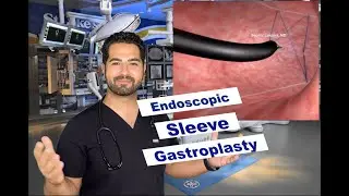 Endoscopic sleeve gastroplasty (ESG) - Endosleeve