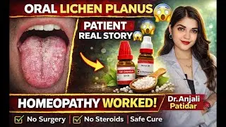 Oral Lichen Planus Ka Asli Ilaaj 😱 | Patient Real Story | Homeopathy Worked