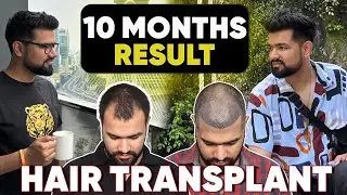 Hair Transplant in Delhi (HX-DPNV) | Best Results & Cost of Hair Transplant in Delhi