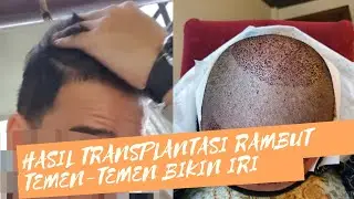 HASIL YANG SUDAH TRANSPLANTASI RAMBUT | #PEJUANGGANTENG