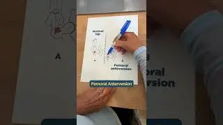Hip Subluxation!