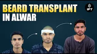 Beard Transplant In Alwar: Watch This First | IFT Hair Science