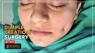 How To Get Dimples Quickly ? Permanent Dimple Creation Surgery By Dr. Prashant Yadav | Dezire Clinic
