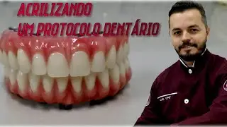 Acrilização de um protocolo dentário / mandíbular