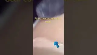 Scar coverup tattoo with skin color