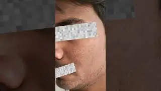Skin peeling after treatment with yellow peel #yellowpeel #chemicalpeeling #antiacne #skinwhitening