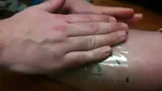 Application of SALSA ChemoVAC Device To Wound
