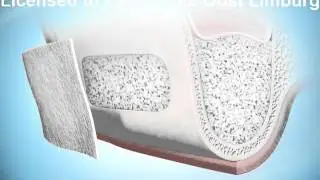 Sinus Lift Procedure (botreconstructie)