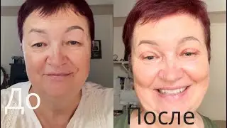 Блефаропластика верхних век.|Как это было. | И как я изменилась.