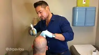 Platelet Rich Plasma (PRP) procedure by Dr. Pavlou