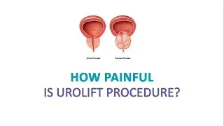 How Painful is Urolift Procedure ?
