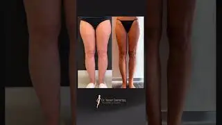 1 Year After VASER Lipo: 7L Fat Gone! 🔥🦵 #LipedemaSurgery