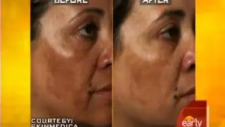 Chemical Peels Montclair | Dr. Jeanine Downie | Image Dermatology