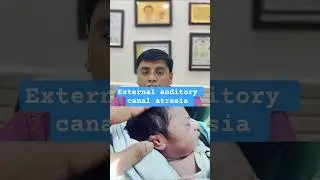 EXTERNAL AUDITORY CANAL (EAC) ATRESIA 👂 क्या होता है।। #ent #earproblem