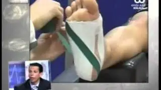 Fascitis Plantar. Diagnóstico, tratamiento y consejos