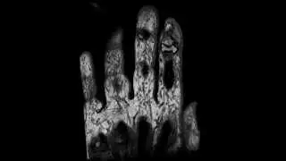 Rapid and high resolution MRI of upper extremities at 1.5 Tesla