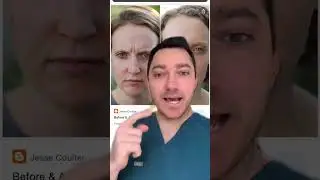 Frown Lines aka Eleven Lines aka The 11's how to treat them - TikTok SkinDoc