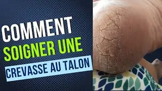 TALONS FISSURES CAUSES POSSIBLES A CONNAITRE
