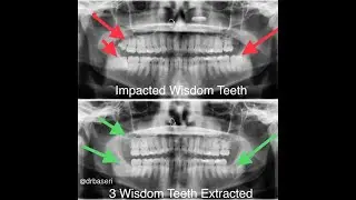 Overcoming Dental Phobia | Gentle Dentist Los Angeles