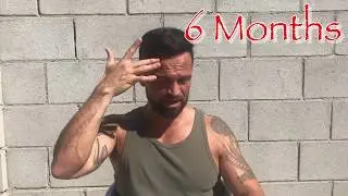 6 MONTHS | 2nd Procedure | Hair Medical Restoration | Tijuana | 6 Months Minoxidil Use