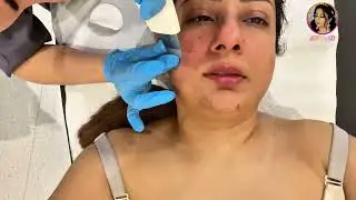 Hydra Facial 