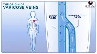 How to treat Venous Reflux?