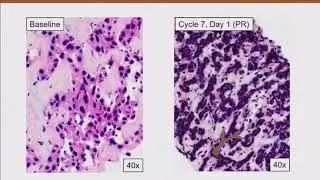 2018 Cholangiocarcinoma Foundation Annual Conference #16 - Day 2 - IDH Inhibitor Trials