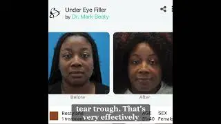 Under eye filler can make a big difference in the appearance of the face.  before and afters