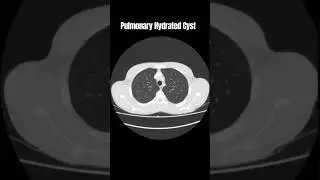 ✨Pulmonary hydrated cyst✨ #neuroscience #anatomy #neurology #radiographer_exam #neurology#motivation