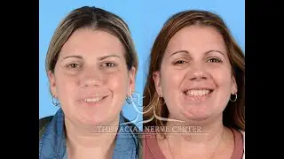SMILE REANIMATION | Before & After 2