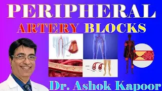 PERIPHERAL ARTERY BLOCKS  || Dr. Ashok Kapoor